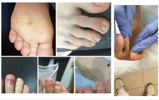 Lesioni cutanee ai piedi tra i possibili sintomi dell’infezione da coronavirus